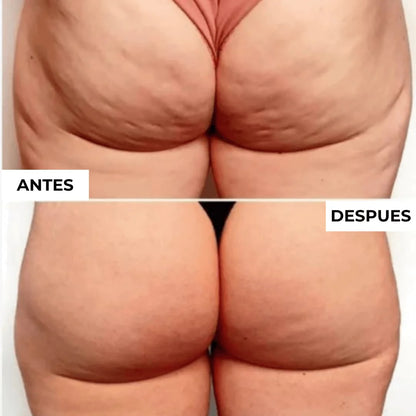 Gua Sha Anti-Celulitis (3x1)